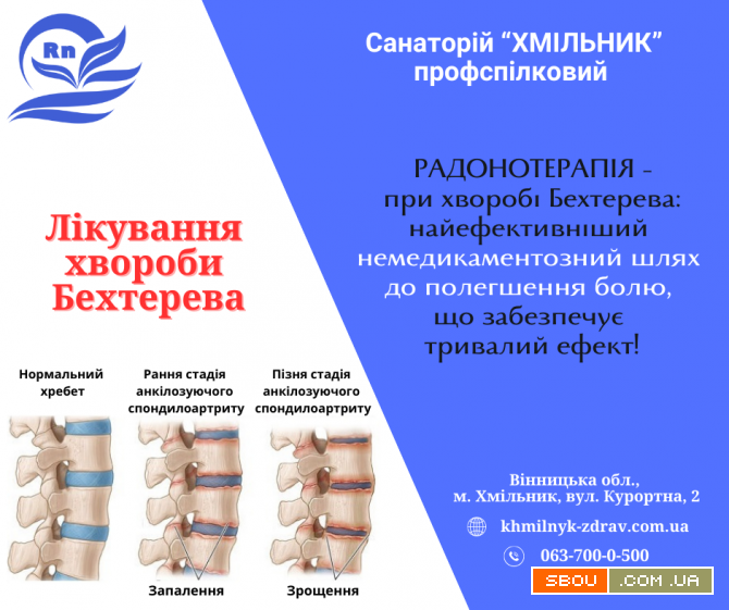 Лікування хвороби Бехтерева у санаторії «Хмільник» Хмельник - изображение 1